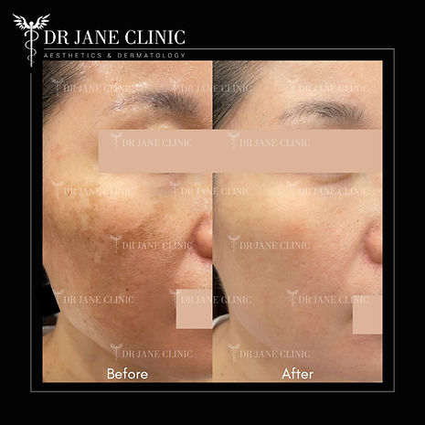 Pico Laser melasma before and after results Malaysia