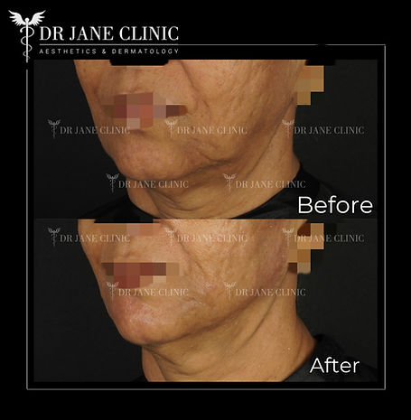 Before and after jawline contouring and lifting treatment showing a sharper, more defined jawline.