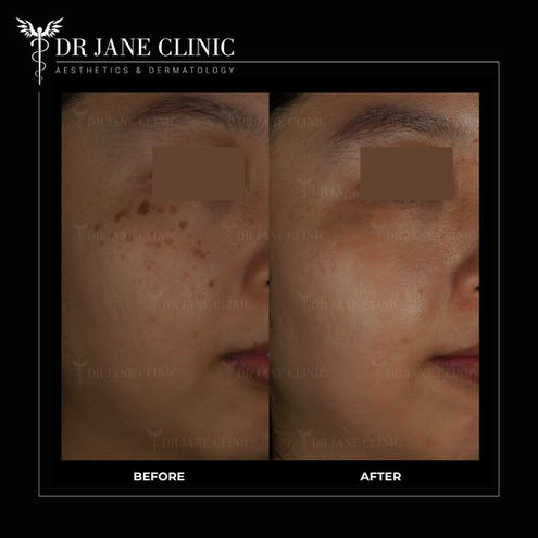 Pigmenation removal with Pico laser