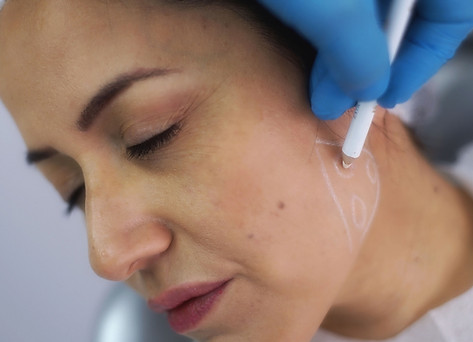 image of a woman getting her jawline drawn, in preparation for jawline filler treatment