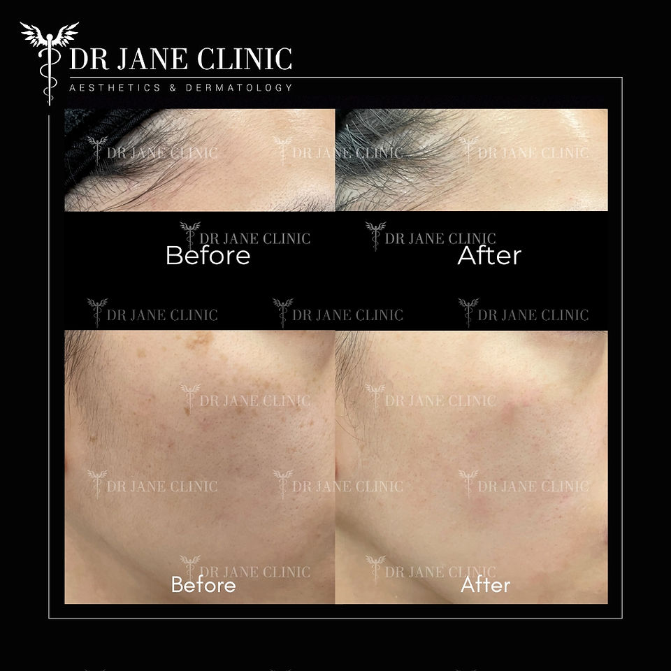 Before & after Pico Laser 