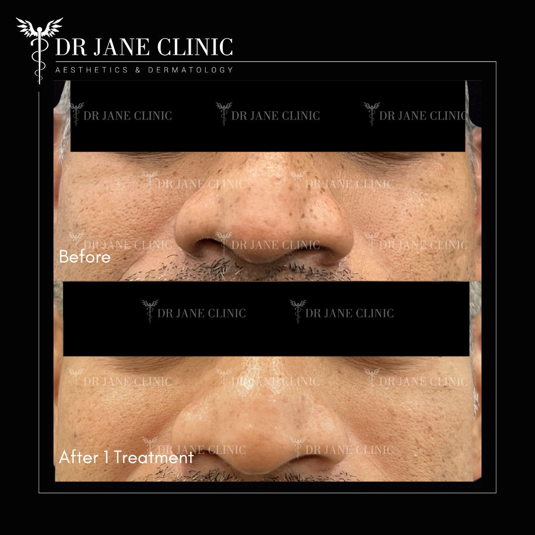 Before & after Pico Laser