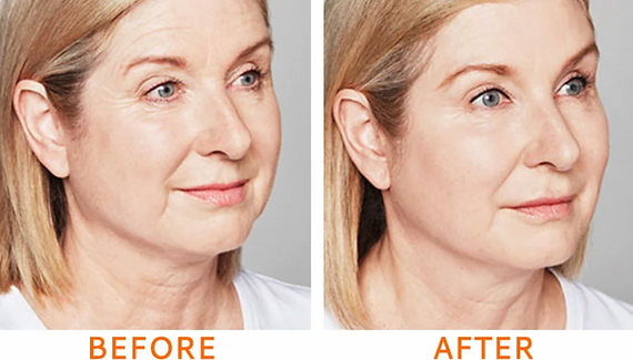 Volite Skin Booster