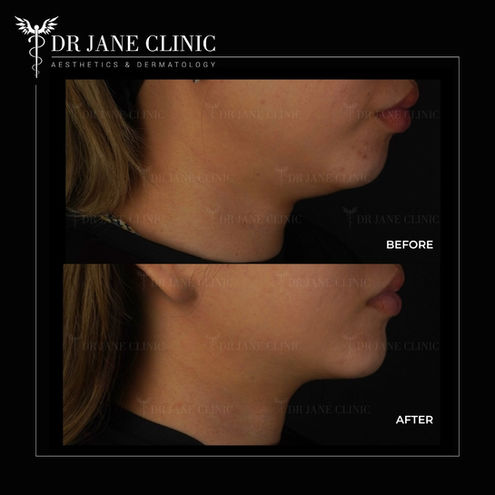 Double chin removal at Dr Jane Clinic