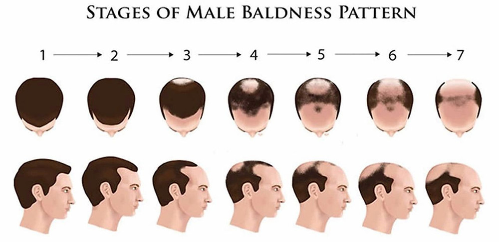 Androgenic Alopecia 