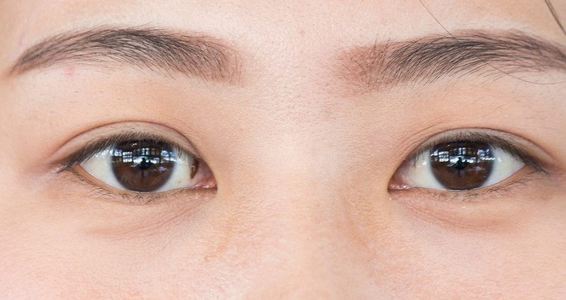 closed up of the eyes with tear trough, hollowness under the eyes