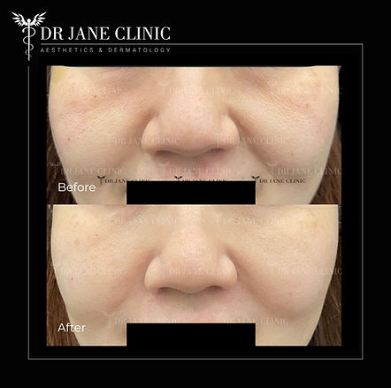 before and after nasolabial fold filler on female patient – softened smile lines