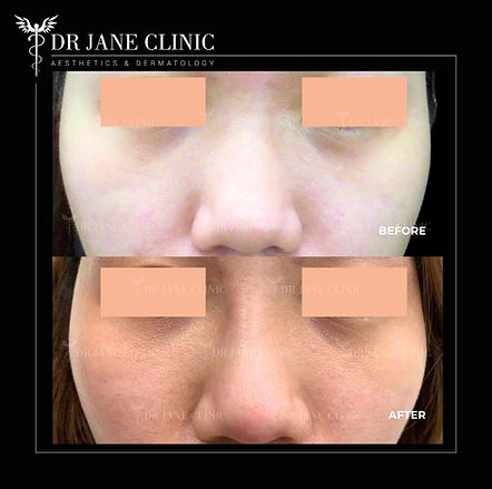 Before and after nose filler in Malaysia