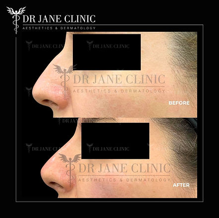 Results of nose filler enhancement