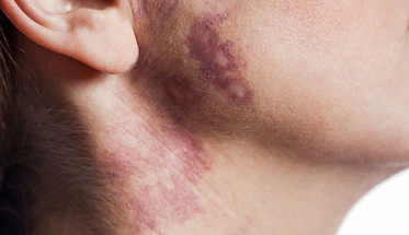 Port wine stain birthmark is to be treated with pulse dye laser