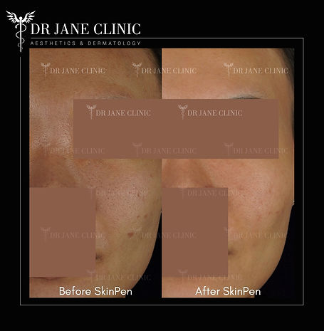 Before and after microneedling treatment showing smoother skin and reduced acne scars.
