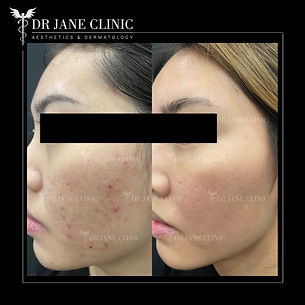 Skin result after acne treatment