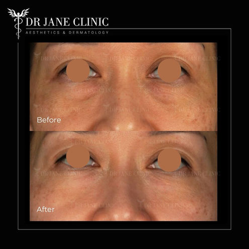 Non surgical eye bag reduction in Malaysia