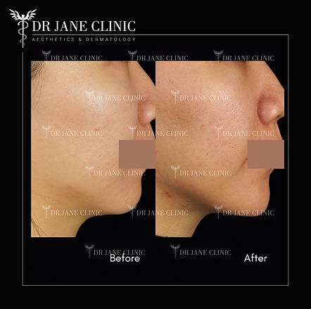 Before and after chin dermal filler treatment