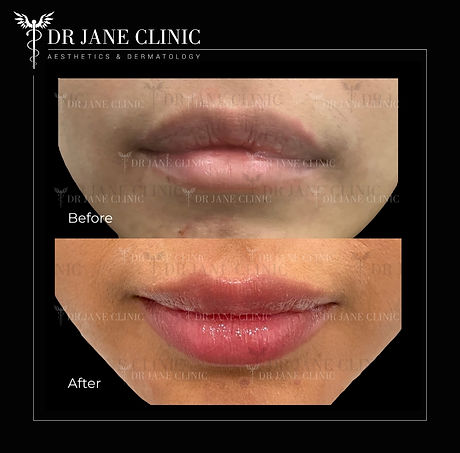 Before and after images of lip filler highlighting soft, natural-looking results