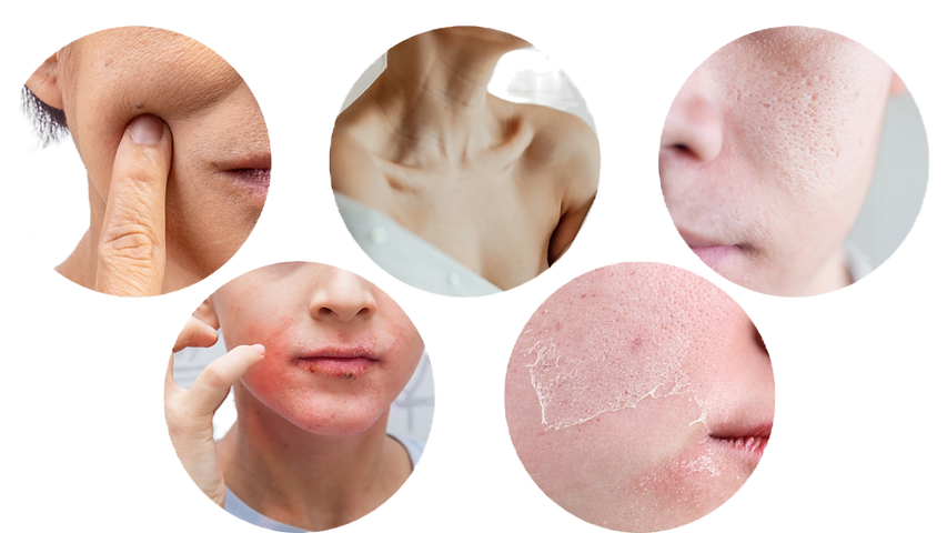 different skin conditions which is suitable for Plinest & Newest treatment