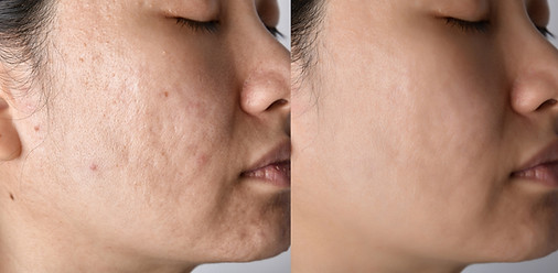 2 photo comparison before and after CO2 laser result