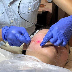Endolift procedure at Dr Jane Clinic