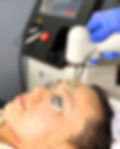AdvaTx Laser for facial redness, telengiectasia, inflamed acne and more