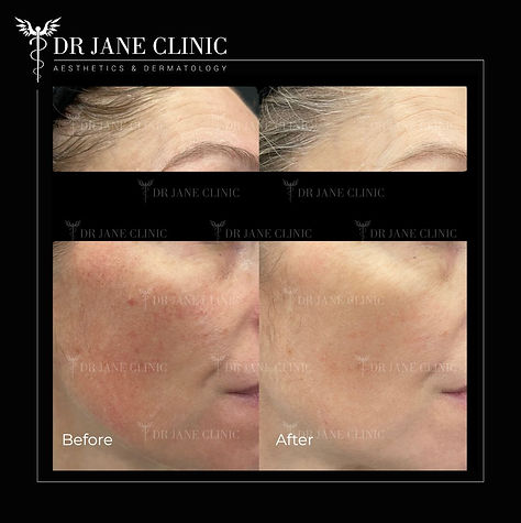 Vascular laser reduces redness and broken capillaries.