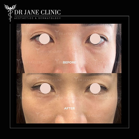 Before and after result of Endolift eye bag removal without surgery Malaysia