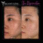 Before & After LaseMD Ultra