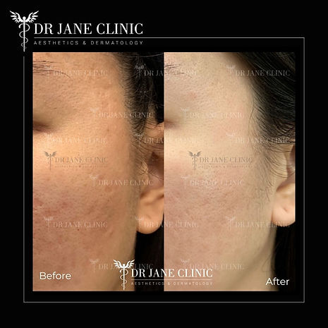 Pico Laser acne scar before and after – skin texture improvement Malaysia
