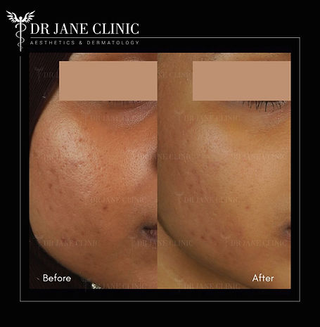 Before and after dermal filler treatment for acne scars in Petaling Jaya, Malaysia.