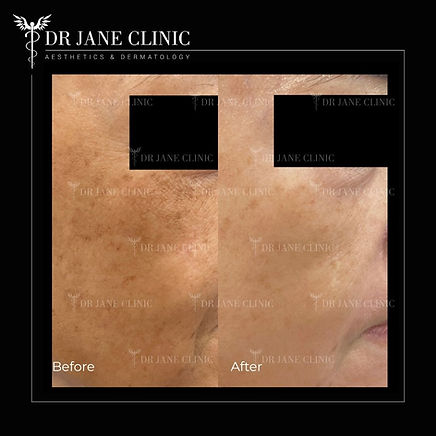 Melasma laser treatment Malaysia – before and after photos of facial pigmentation