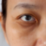 Dark Eye Circles treatment in malaysia