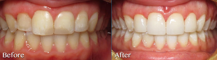 Replace unesthetic white fillings with veneers