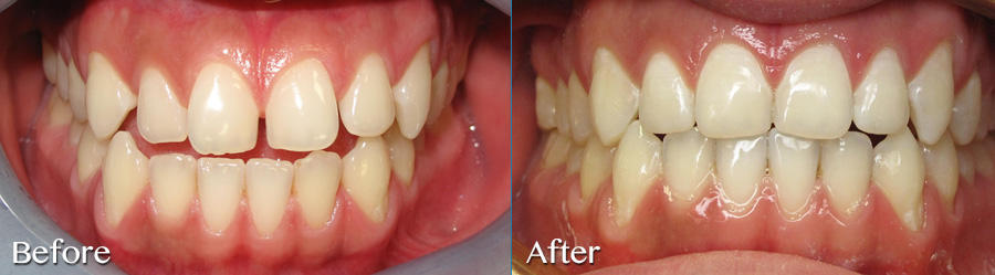 Close excess spacing with Invisalign