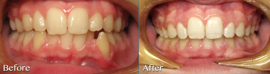 Resolve crowding with conventional orthodontic treatment