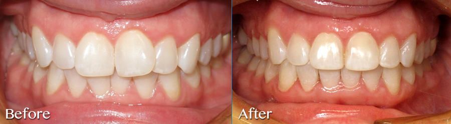 Resolve crowding with Invisalign