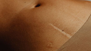 Isthmocele : traiter ou attendre ? Le dilemme continue