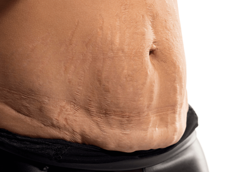 lose skin
