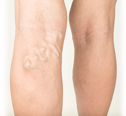 moderate-varicose-veins-head.jpg
