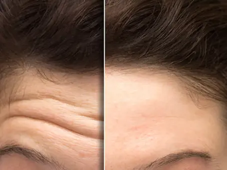 Frown Lines and Forehead Lines: Causes, Prevention, and Treatment Explained