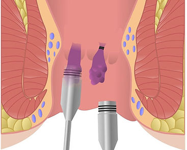 Haemorrhoid-treatments.jpg