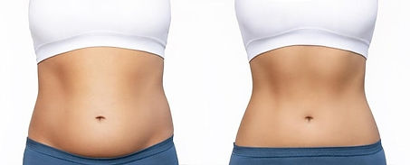 coolsculpting-before-after-abdomen-results.jpg