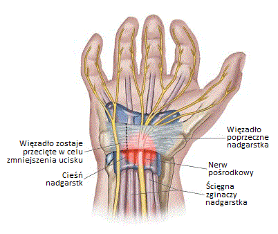 Zespół cieśni kanału nadgarstka cz. I