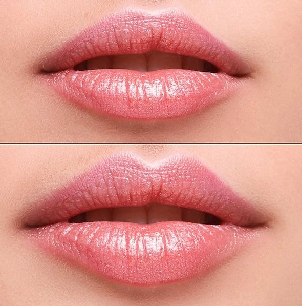 640e2a97aa58d35d39628fcc_botox and injectables, before and after.jpg