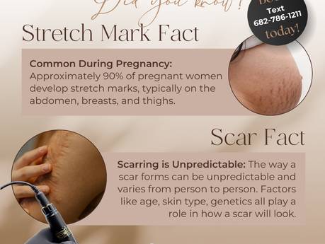 Stretch Mark + Scar Facts