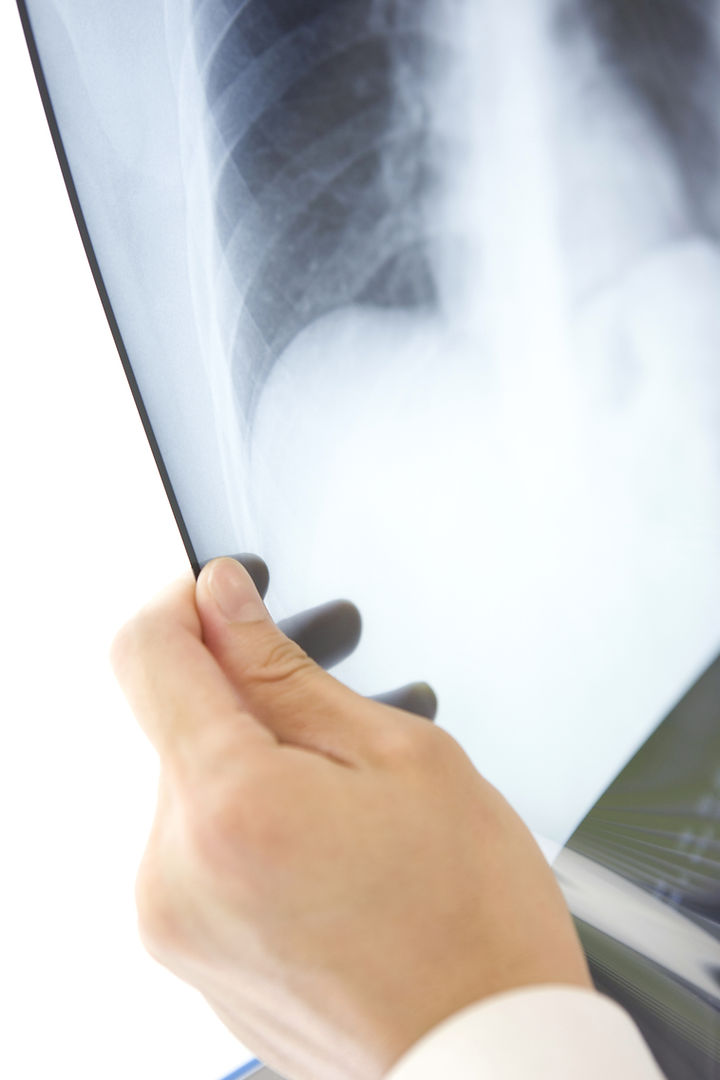 X-Ray