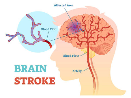 Had a Stroke! Oh my!