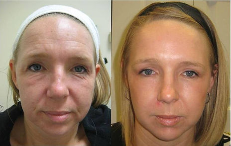 Benevita- Plan 10-10 Rejuvenecimiento facial