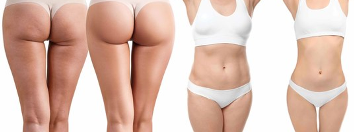 beforeafterbody.webp