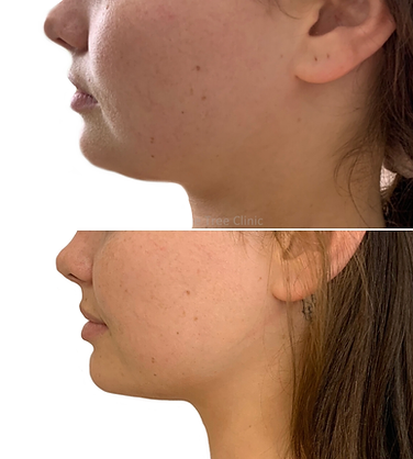 lipolax before and after.webp