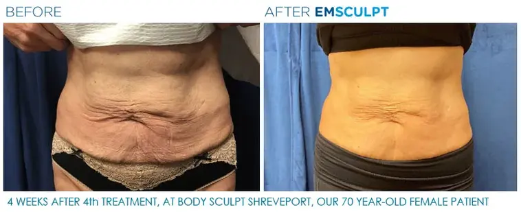 Woman in her 70s receiving non-surgical abdomen body sculpting treatment at Clinique Novomedic in Montreal