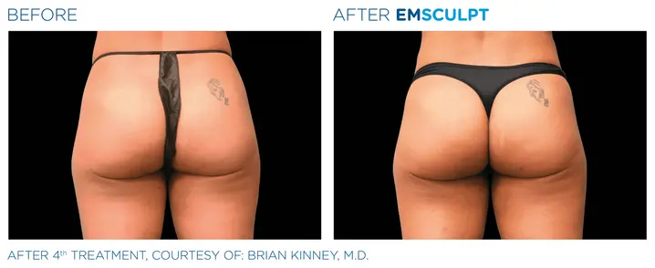 Non-surgical gluteal body contouring treatment at Clinique Novomedic in Montreal